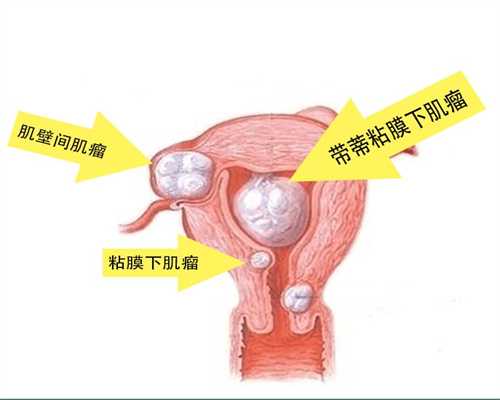 子宫下垂的症状是什么